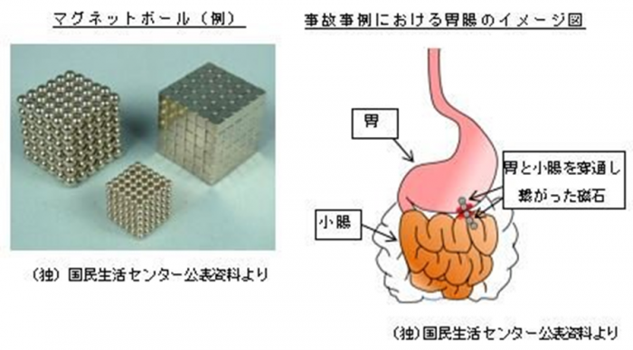 マグネットボールと事故事例における胃腸のイメージ図